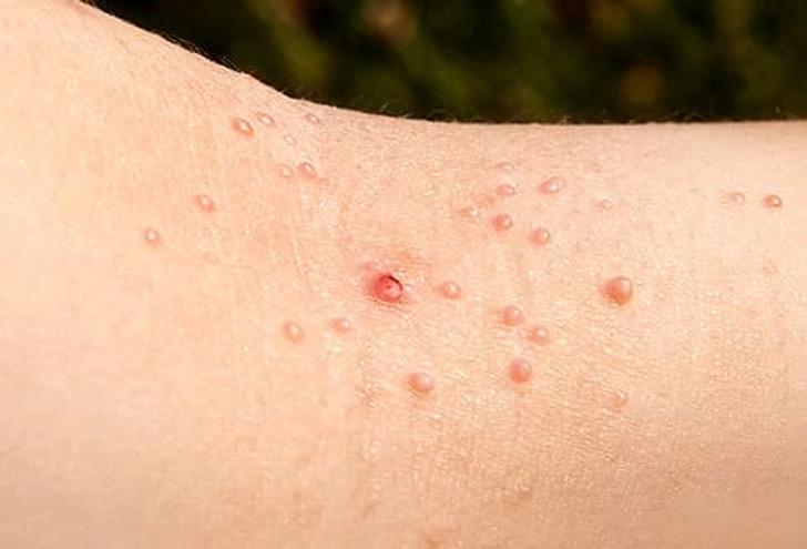 CẢNH BÁO: 4 kiểu mụn rất dễ là "lớp ngụy trang" của bệnh ung thư nhưng ít người để ý- Ảnh 2. CẢNH BÁO: 4 kiểu mụn rất dễ là "lớp ngụy trang" của bệnh ung thư nhưng ít người để ý- Ảnh 2.