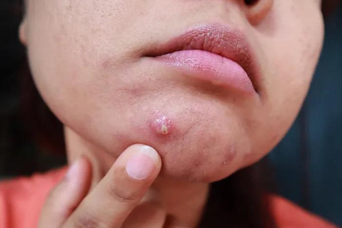 CẢNH BÁO: 4 kiểu mụn rất dễ là "lớp ngụy trang" của bệnh ung thư nhưng ít người để ý- Ảnh 3. CẢNH BÁO: 4 kiểu mụn rất dễ là "lớp ngụy trang" của bệnh ung thư nhưng ít người để ý- Ảnh 3.