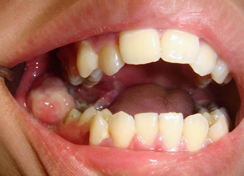 4 dấu hiệu răng miệng cảnh báo ung thư đang "tiến sát cửa nhà"- Ảnh 2.