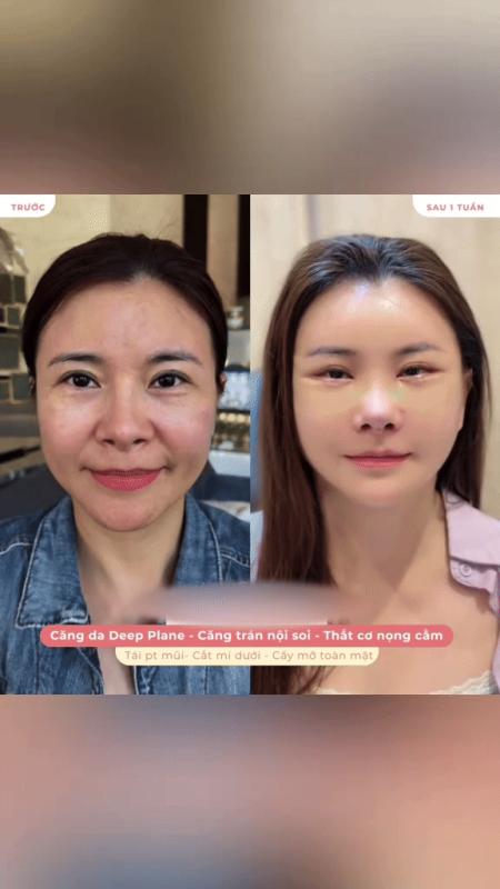 Diễn viên Kim Oanh để lộ chiếc cằm dài ngoằng lạ lẫm hậu 