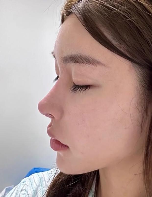 Những dấu hiệu bạn đang bị biến chứng sau khi làm mũi- Ảnh 4.