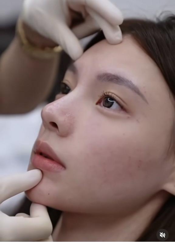 Những dấu hiệu bạn đang bị biến chứng sau khi làm mũi- Ảnh 2.