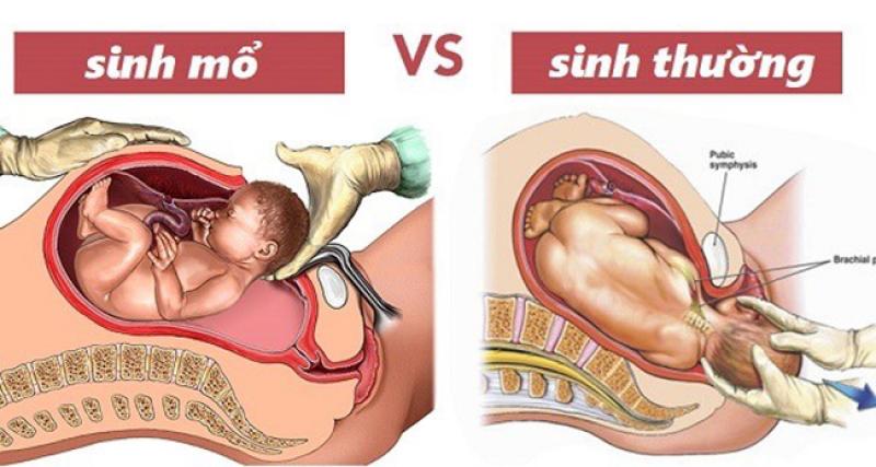 Chọn giờ sinh mổ để được 