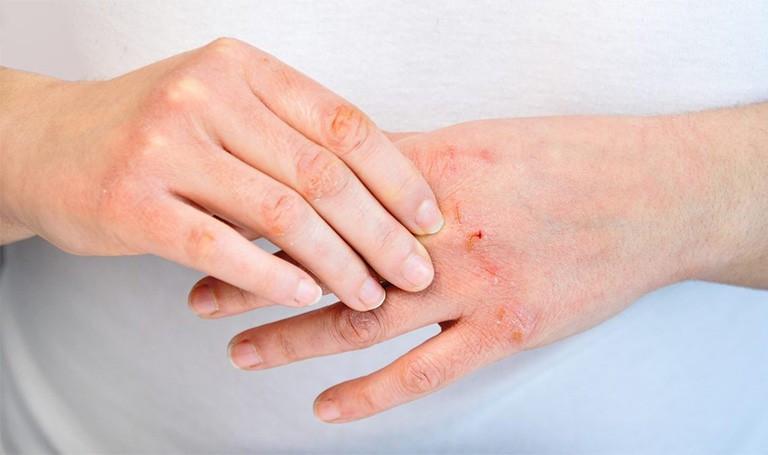 Mưa bão, lụt lội: Cẩn trọng với nguy cơ bỏng và mắc các bệnh về da- Ảnh 1.