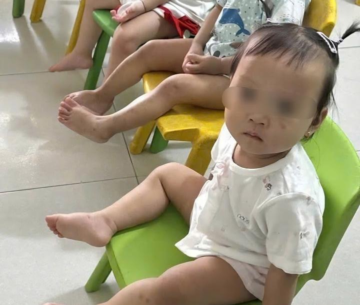 Tình trạng sức khỏe bé gái 1 tuổi bị bầm tím mặt khi gửi nhà trẻ ở Bắc Ninh- Ảnh 1.