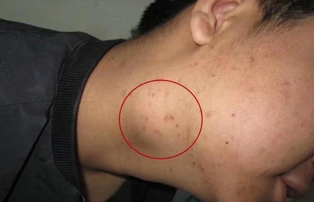 Loại ung thư có thể xuất hiện ở bất cứ vị trí nào trên cơ thể, không để ý 5 dấu hiệu này dễ "hối không kịp"- Ảnh 1.