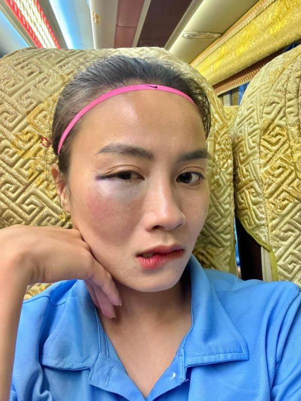 Hotgirl bóng đá Hoàng Thị Loan để lộ vùng mắt sưng vù sau pha va chạm trên sân bóng khiến fan cực xót- Ảnh 2.