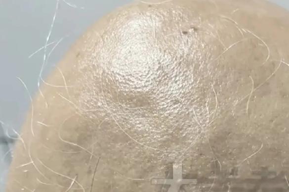 Cô gái 20 tuổi rụng sạch lông tóc chỉ trong 1 tháng sau chia tay người yêu- Ảnh 1.