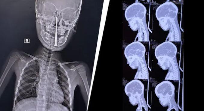 Phẫu thuật cho bé trai 7 tuổi, bác sĩ sốc nặng khi lấy ra "thứ đáng sợ"- Ảnh 1.