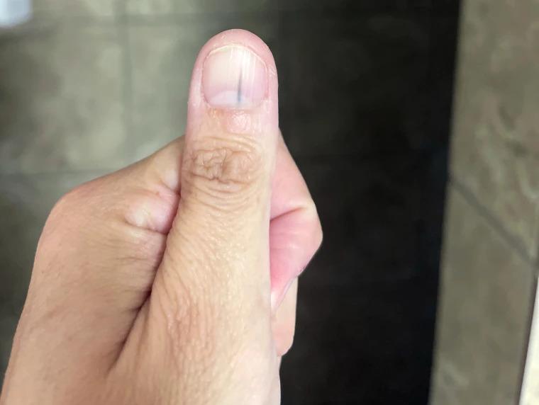 SOS với 5 dấu hiệu ung thư lộ rõ trên móng tay, nhiều người không hiểu vẫn "bình chân như vại"- Ảnh 1.