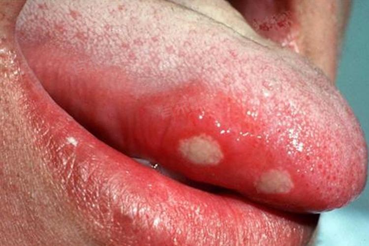 Xin chia buồn! Bạn đã trở thành "con mồi" của tế bào ung thư nếu lưỡi xuất hiện 5 thay đổi- Ảnh 1.