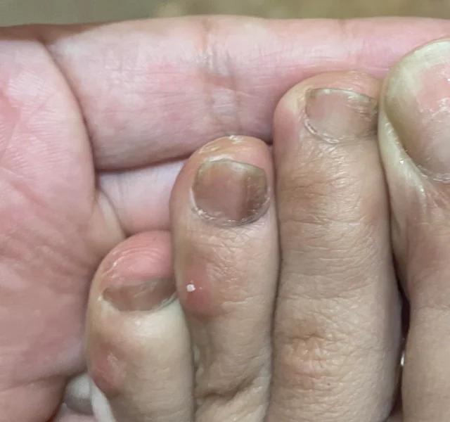 Bàn chân của người "giấu" ung thư thường có 5 khác biệt, chỉ mong bạn không đen đủi có cái nào!- Ảnh 3.