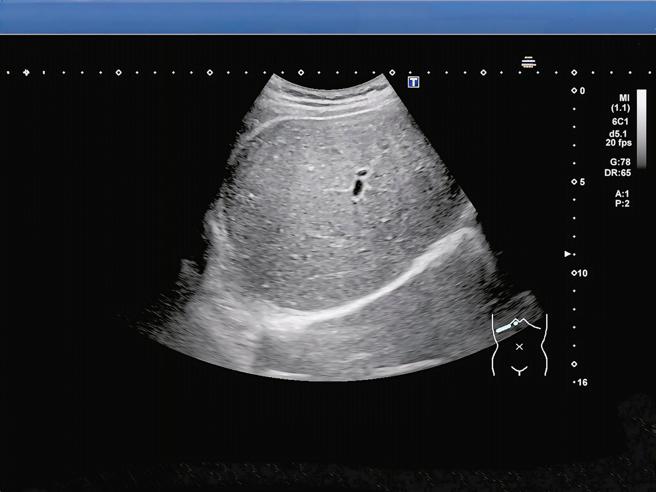 Nam sinh có gan trắng xoá, ngập trong mỡ: Bác sĩ nói thẳng “do 2 món khoái khẩu nhiều người mê”- Ảnh 1.