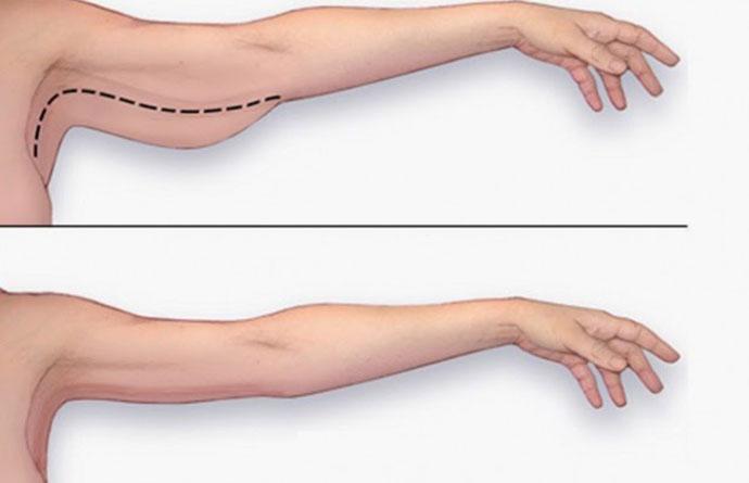 Nói được lời tạm biệt cánh tay nhão nhoét ở tuổi 34 nhờ bữa ăn 5 phút mỗi ngày- Ảnh 1.