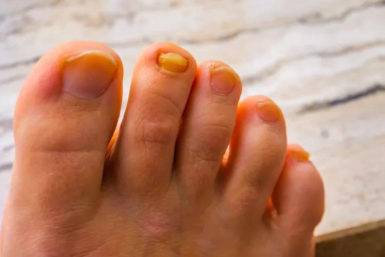 5 thay đổi ở bàn chân là tín hiệu gan "kiệt quệ", chỉ sợ mắc ung thư từ lâu- Ảnh 3.