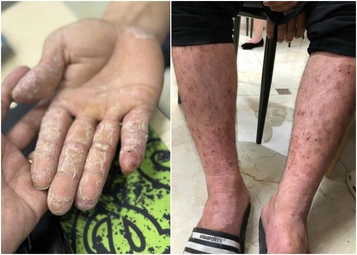 Những bệnh về da thường gặp sau mưa lũ- Ảnh 1.