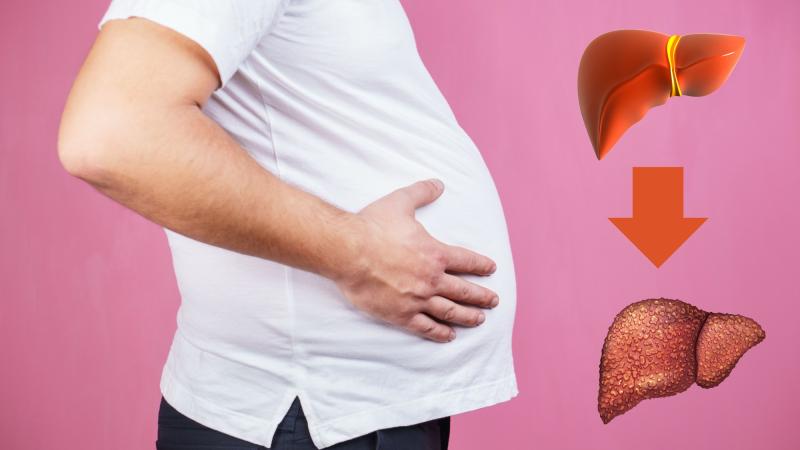 Đây là 6 triệu chứng sớm nhất của ung thư gan: Nhiều người không biết nên bỏ qua- Ảnh 4.
