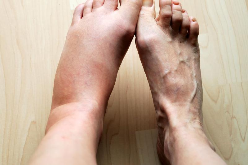 5 thay đổi ở bàn chân là tín hiệu gan "kiệt quệ", chỉ sợ mắc ung thư từ lâu- Ảnh 1.