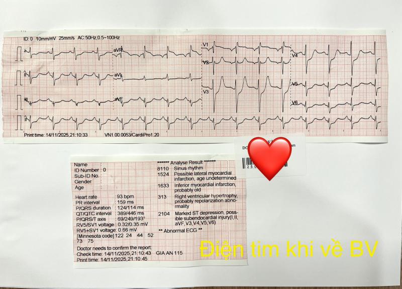 Người đàn ông 52 tuổi không qua khỏi vì người nhà dùng mẹo vắt chanh vào miệng khi hôn mê- Ảnh 3.