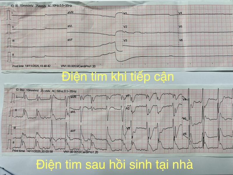 Người đàn ông 52 tuổi không qua khỏi vì người nhà dùng mẹo vắt chanh vào miệng khi hôn mê- Ảnh 2.