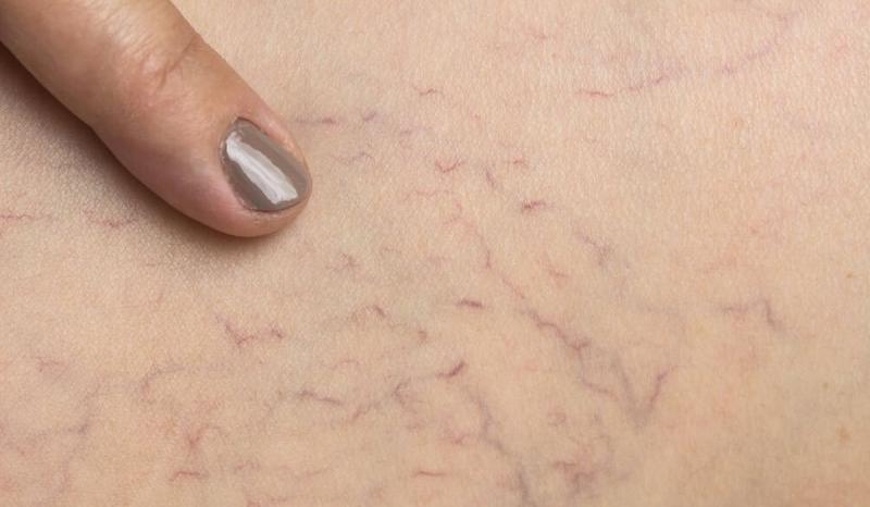 Nhìn tay và chân cũng có thể biết gan bị tổn thương hay không: Đây là 5 dấu hiệu cần lưu ý- Ảnh 4.