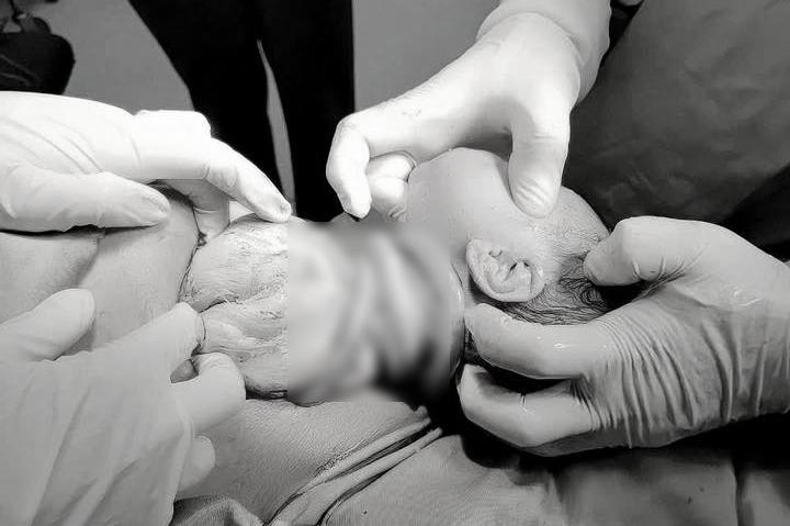 Bé gái chào đời với 6 vòng dây rốn quấn cổ, mẹ tiền sản giật- Ảnh 1.