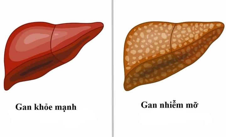 Người bị xơ gan, gan nhiễm mỡ do rượu bao lâu nên khám một lần?- Ảnh 1.
