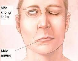 Nhà sáng lập thương hiệu Cà Mèn qua đời ở tuổi 34 vì đột quỵ: Căn bệnh tăng cao khi trời lạnh, có 4 dấu hiệu nhận biết sớm nhiều người bỏ qua- Ảnh 3.