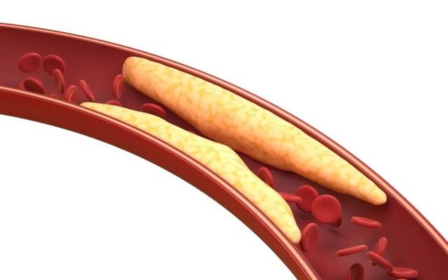 Sáng dậy mà thấy 4 điều này thì đừng đổ tại ‘ngủ chưa đủ’ nữa: Cơ thể đang kêu cứu vì mỡ máu quá cao!- Ảnh 1.