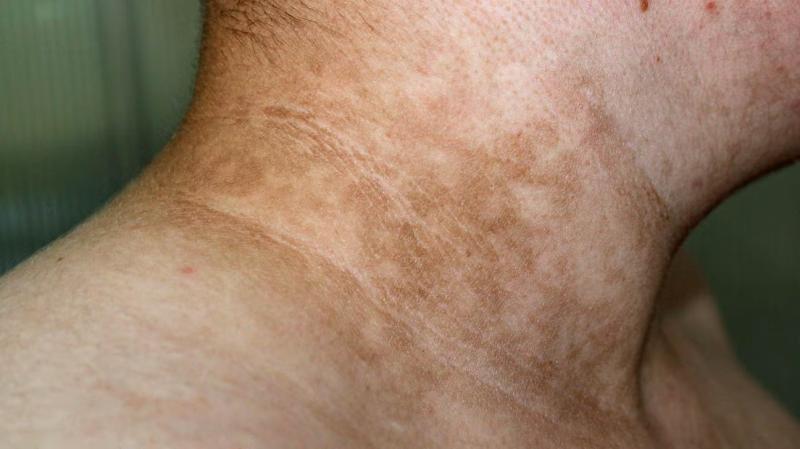 7 vị trí trên cơ thể thường chuyển sang MÀU ĐEN khi ung thư xuất hiện, tự kiểm tra ngay!- Ảnh 1.