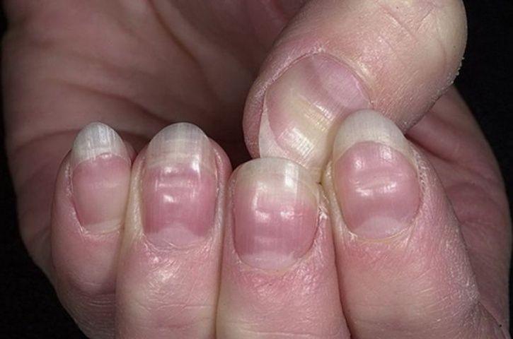 6 bất thường ở bàn tay đang ám chỉ lượng đường trong máu vượt ngưỡng an toàn, tiếc là rất ít người để ý!- Ảnh 3.