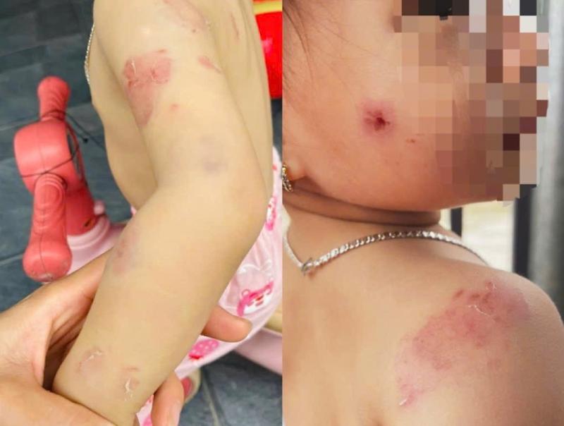 Phụ huynh bức xúc khi con gái hơn 2 tuổi chi chít vết cắn trên người sau giờ học- Ảnh 1.
