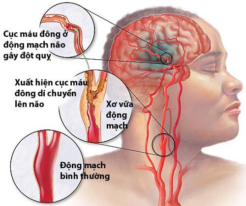 Đột quỵ mùa lạnh: Nỗi ám ảnh 