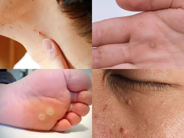 Cô gái 19 tuổi nhiễm cùng lúc 8 chủng HPV: Khi sự chủ quan của tuổi trẻ có thể phải trả giá bằng sức khỏe sinh sản- Ảnh 3.