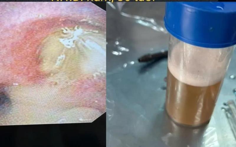 Cảnh báo hai ca viêm phổi nặng do sặc dầu- Ảnh 1.