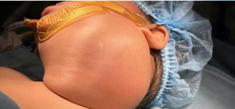 Cắt bỏ khối u nang bạch huyết khổng lồ cứu bé gái 2 tuổi- Ảnh 2.