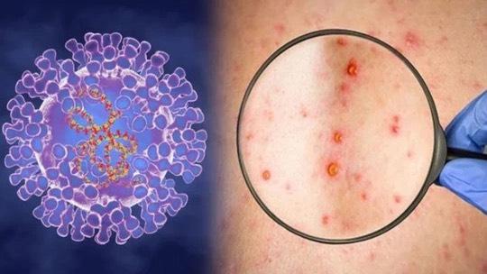Xuất hiện ca bệnh đậu mùa khỉ chưa rõ nguồn lây ở Đồng Nai- Ảnh 1.