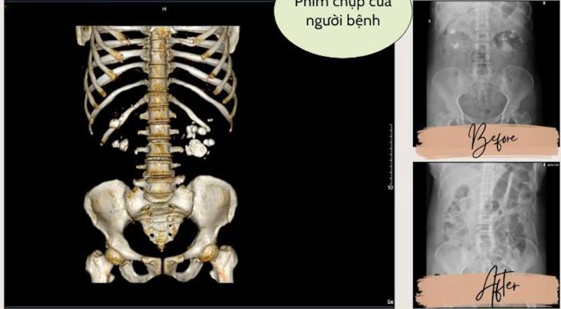 Xem phim chụp CT, bác sĩ "tá hỏa" khi thấy điều không ai ngờ trong thận người bệnh- Ảnh 1.