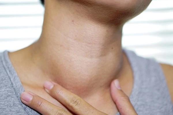 Sinh viên Đại học Bách khoa năm cuối bị basedow nhiều năm, bác sĩ hỏi vẫn không biết mình mắc bệnh gì- Ảnh 3.