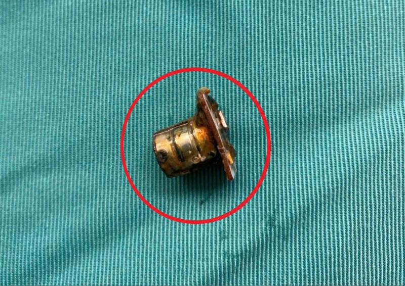 Bé 2 tuổi đang chơi bỗng ho tím tái, bác sĩ gắp ra thứ "đáng sợ" trong bụng- Ảnh 1.