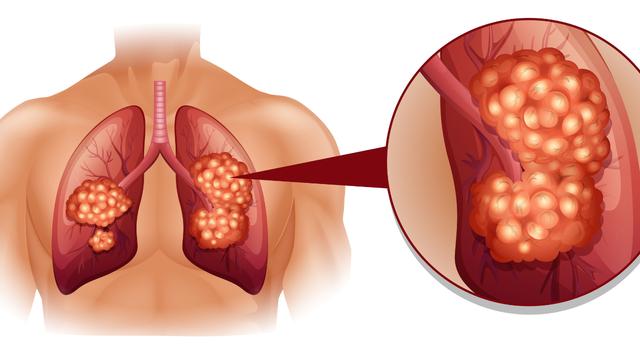 Không phải ngẫu nhiên mà nhiều gia đình liên tiếp có người mắc ung thư: Đây là 6 bệnh ung thư có tính di truyền rõ rệt- Ảnh 4.