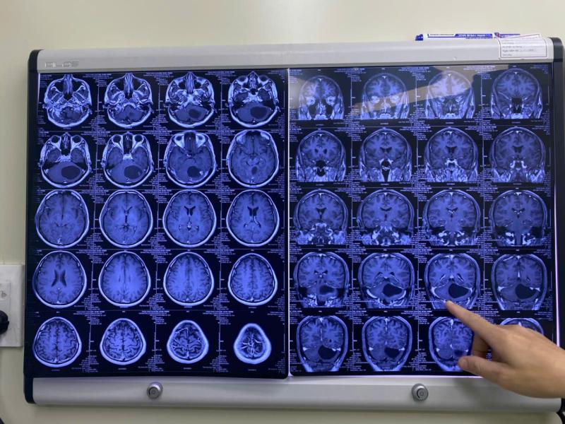 150 phút nghẹt thở với người đàn ông vào bệnh viện trong tình trạng đau đầu dữ dội- Ảnh 1.