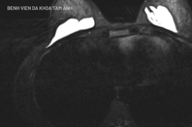 Tháo bỏ chất lạ sau nâng ngực "không xâm lấn"- Ảnh 2.
