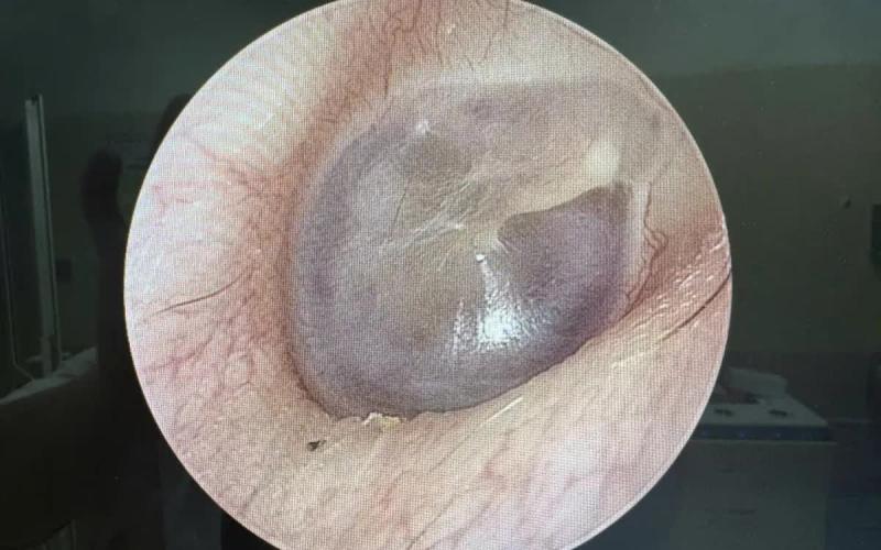 Cholesteatoma bẩm sinh: "Viên ngọc trai" nguy hiểm sau màng nhĩ- Ảnh 1.