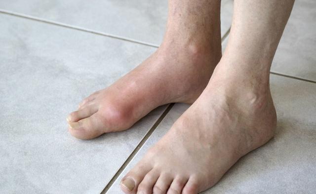Có 2 dấu hiệu đi lại này thì cảnh giác bệnh suy thận sắp "đến cửa"- Ảnh 4.