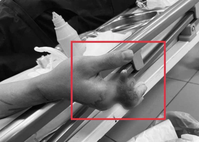 Cuộc mổ xuyên đêm cứu 4 ngón tay dập nát, gần đứt rời- Ảnh 1.