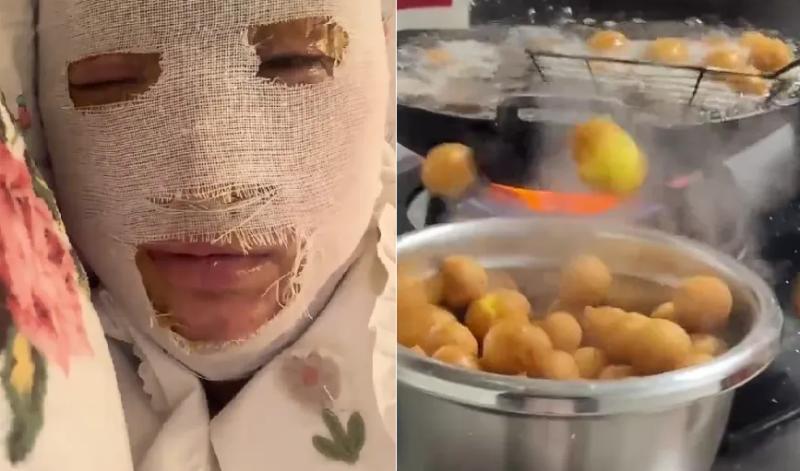 Cô gái suýt biến dạng khuôn mặt khi nấu ăn, cảnh báo 3 thực phẩm dễ 