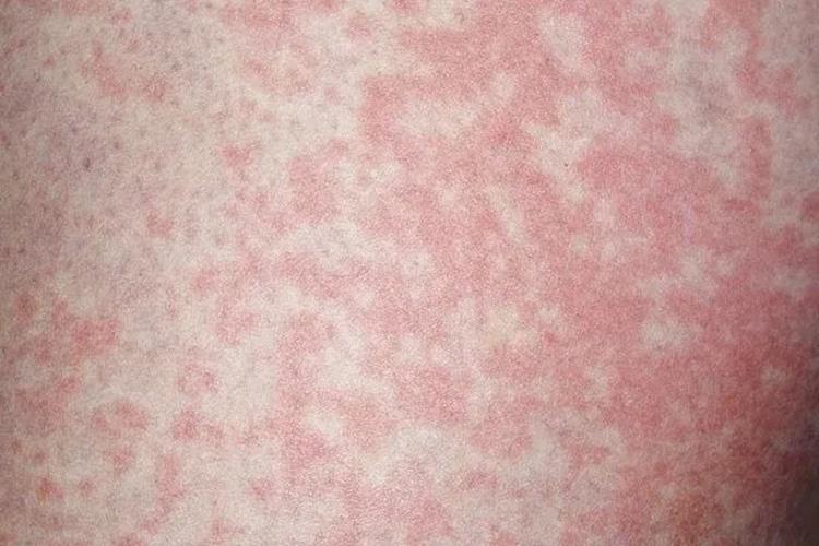 Người đàn ông nhiễm nấm vùng kín vì thói quen nhiều người làm với đồ lót của mình- Ảnh 1.