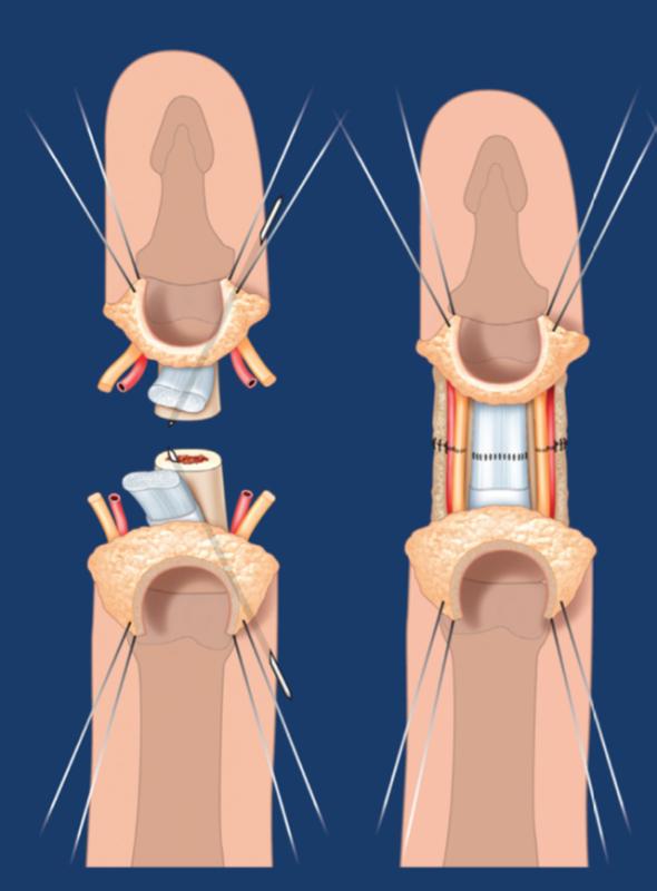 Lần đầu tiên tại Việt Nam: Nối thành công ngón tay bị đứt rời sau 25 giờ thiếu máu cho một thủy thủ- Ảnh 2.