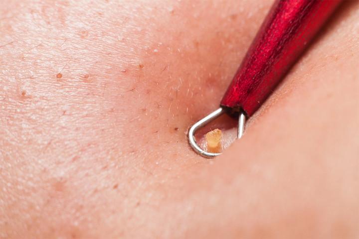 7 lý do nhiều người nghiện xem clip nặn mụn dù trông rất ghê- Ảnh 2.